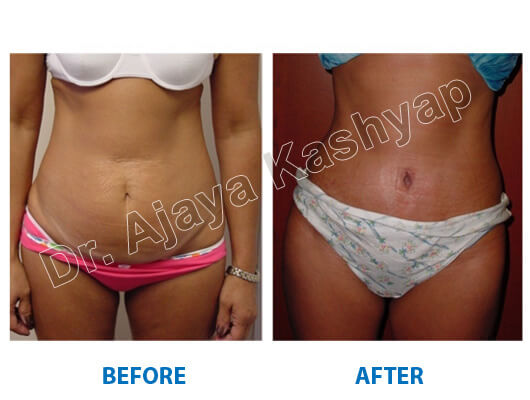 belly button surgery in india