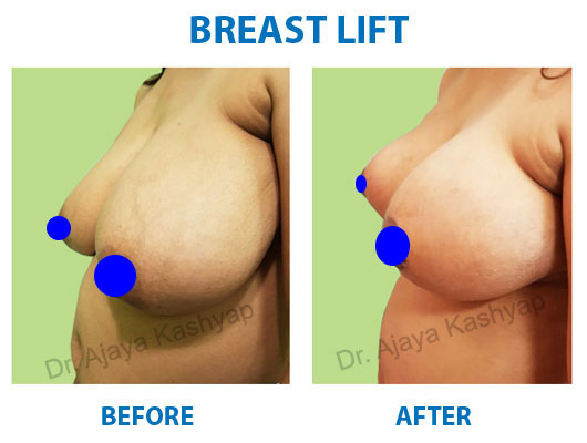 breast lift surgery in india